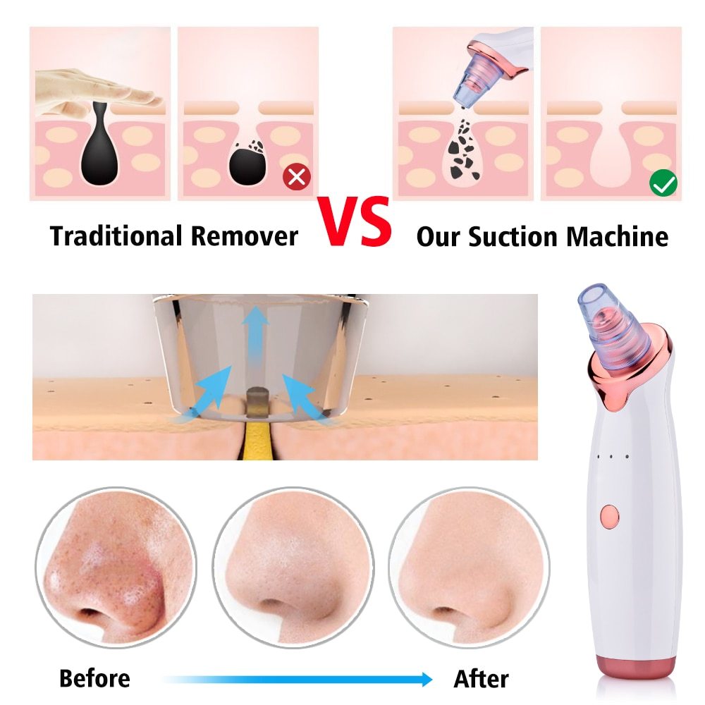 Blackhead Remover Vacuum