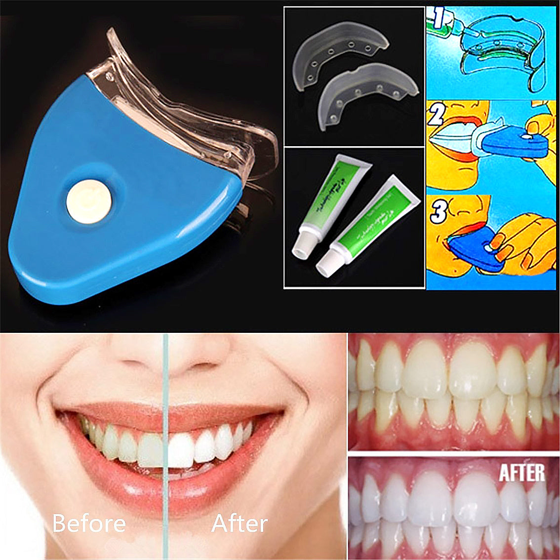 PureGlow Teeth Whitening Kit